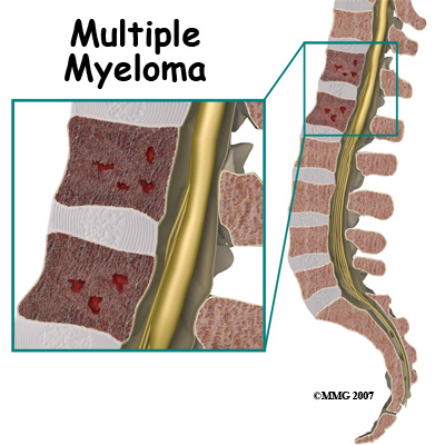 Multiple myeloma tedavisi