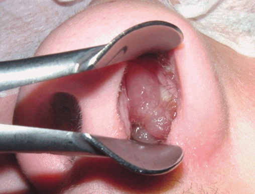 Nasal polip ameliyatı nasıl yapılır?