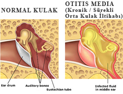 Orta kulak iltihabı (Otitis media)