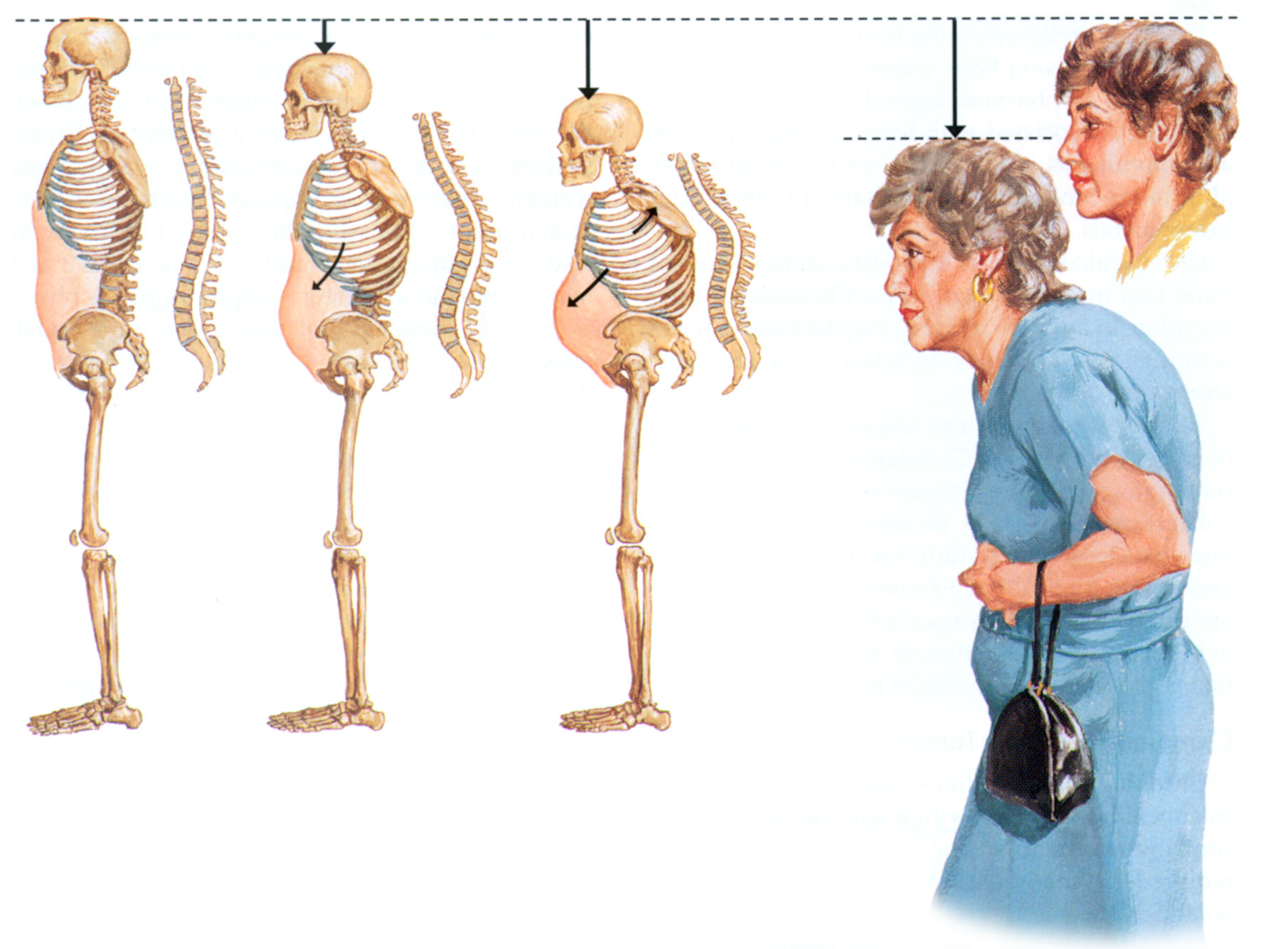 Osteoporoz nasıl önlenir?