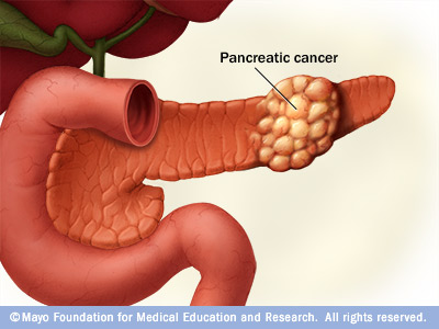 Pankreas kanseri en çok kimlerde görülür?
