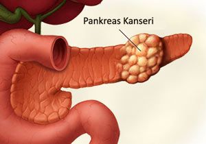 Pankreas kanseri nasıl anlaşılır?