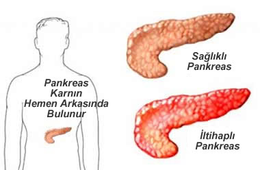 Pankreas Nedir? Pankreas Nedenleri Ve tedavi Yöntemleri