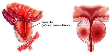 Prostatit