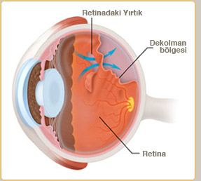 Retina dekolmanı tedavisi
