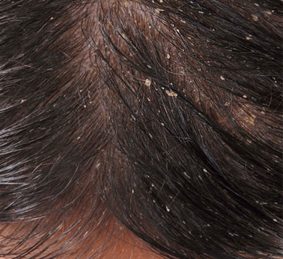 Saç derisinde kuruluk nedenleri