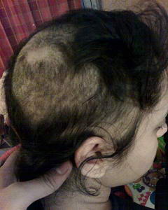 Saç koparma hastalığı tedavisi