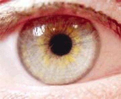 Sarı nokta hastalığı nedir?