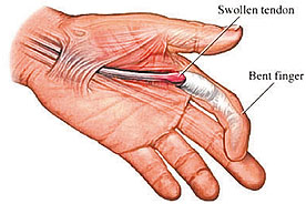 Tetik parmak hastalığı nedir?