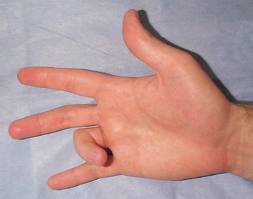 Tetik parmak hastalığı nedir? Nasıl tedavi edilir?