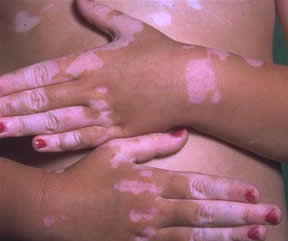 Vitiligo hastalığı nedenleri