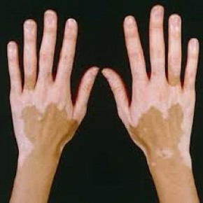Vitiligo hastalığının tedavisi